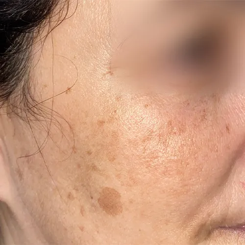 Tratamiento para el Melasma