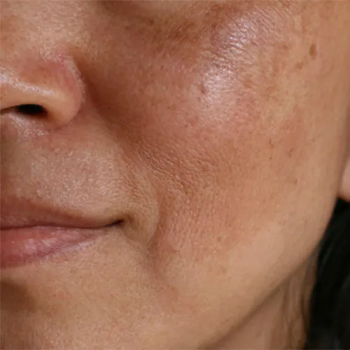 Tratamiento para el Melasma