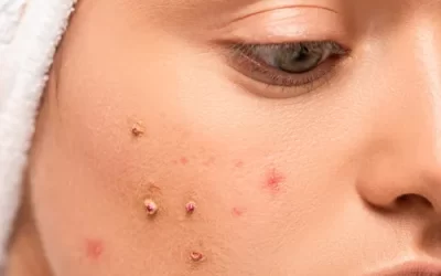 Dermatología y Problemas Cutáneos Frecuentes